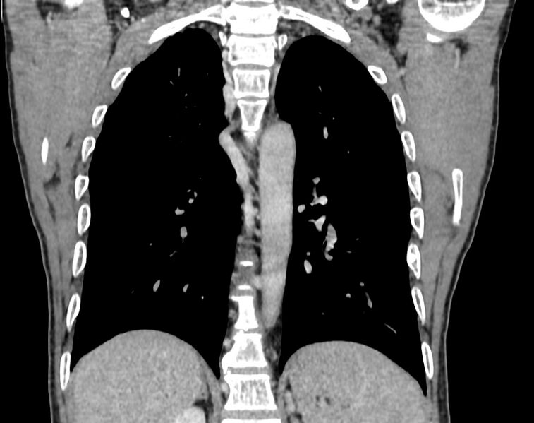 File:Bronchogenic carcinoma with superior vena cava syndrome (Radiopaedia 36497-38054 Coronal C+ delayed 79).jpg