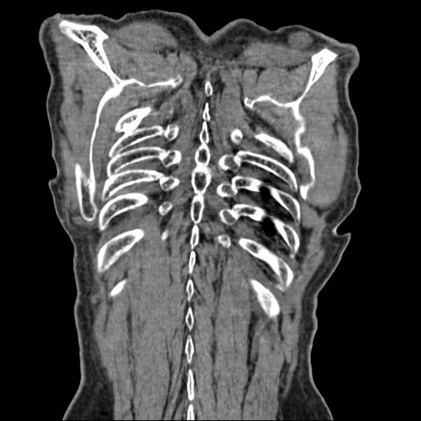 File:Bronchopleural fistula - postoperative complication (Radiopaedia 21020-20947 Coronal non-contrast 27).jpg