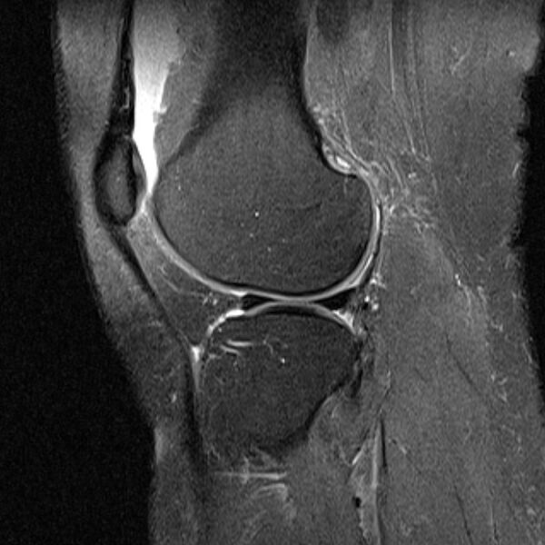 File:Bucket handle tear - medial meniscus (Radiopaedia 79028-91942 Sagittal PD fat sat 6).jpg