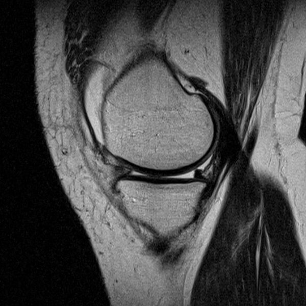 File:Bucket handle tear - medial meniscus (Radiopaedia 79028-91942 Sagittal T2 19).jpg