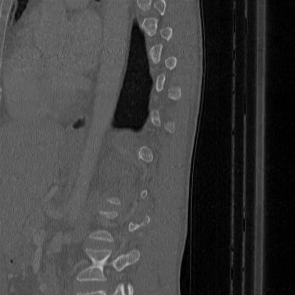 File:Bulging of paraspinal line in traumatic thoracal spinal compression fracture (Radiopaedia 29221-35872 Sagittal bone window 48).jpg