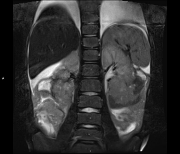 File:Burkitt lymphoma (bowel) (Radiopaedia 68839-78557 Coronal STIR 18).jpg