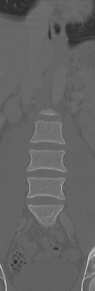 File:Burst fracture - T12 with conus compression (Radiopaedia 56825-63647 Coronal bone window 11).png