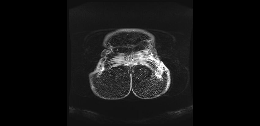Buttock filler complications (Radiopaedia 63497-72115 Coronal T1 C+ 65).jpg