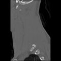 C5 facet fracture (Radiopaedia 58374-65499 Sagittal bone window 18).jpg
