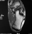 Calcaneal stress fracture (Radiopaedia 11969-45924 Axial T1 1).jpg