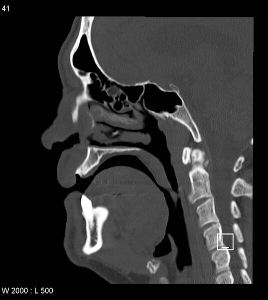 File:Calcification of the transverse band of the cruciform ligament (Radiopaedia 53063-59025 Sagittal bone window 18).jpg