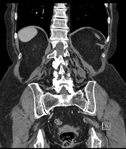 File:Calcified adrenal glands and Spigelian hernia (Radiopaedia 49741-54988 B 88).jpg