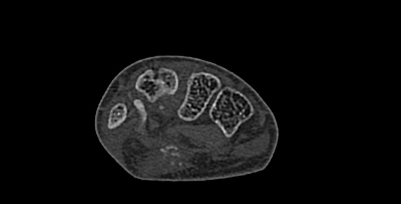 File:Calcifying aponeurotic fibroma (Radiopaedia 88423-105064 Axial bone window 107).jpg