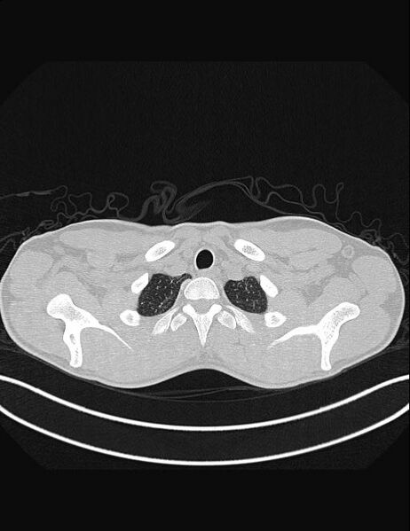File:Calcifying pulmonary metastases (Radiopaedia 33359-34396 Axial lung window 5).jpg