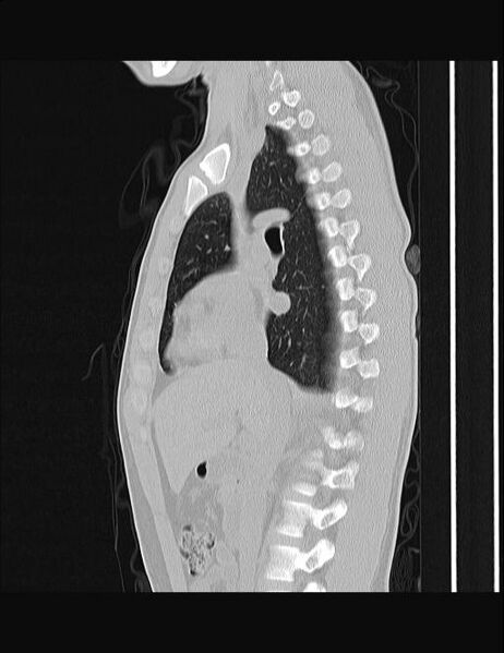File:Calcifying pulmonary metastases (Radiopaedia 33359-34396 Sagittal lung window 41).jpg