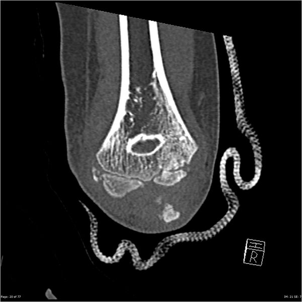 File:Capitellum fracture (Radiopaedia 23352-23426 Coronal bone window 20).jpg