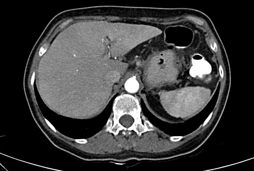 Carcinoid mesenteric tumor complicated by chylous ascites (Radiopaedia 76312-88926 A 15).jpg