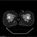 Carcinoma cervix- brachytherapy applicator (Radiopaedia 33135-34173 Axial non-contrast 73).jpg