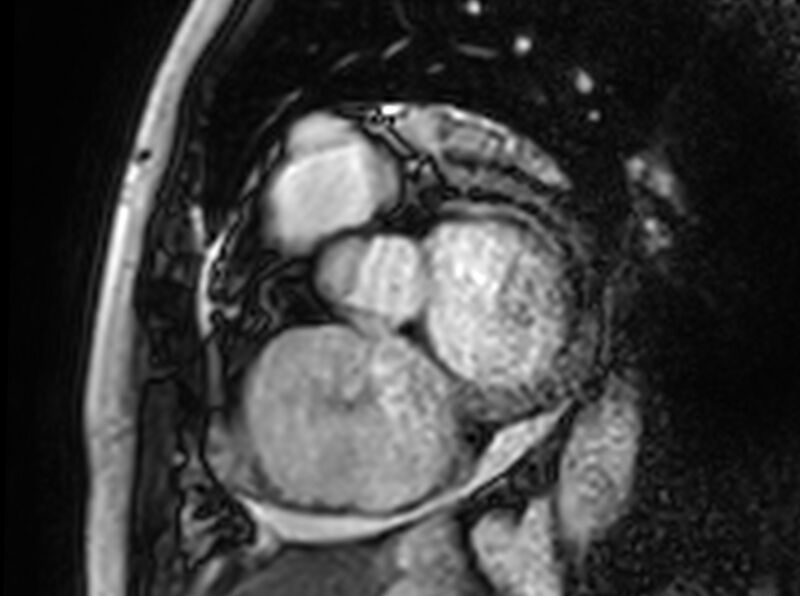 File:Cardiac amyloidosis (Radiopaedia 61600-69579 Short axis bSSFP 307).jpg