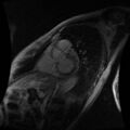 Cardiac fibroma (Radiopaedia 38974-41150 C 11).jpg