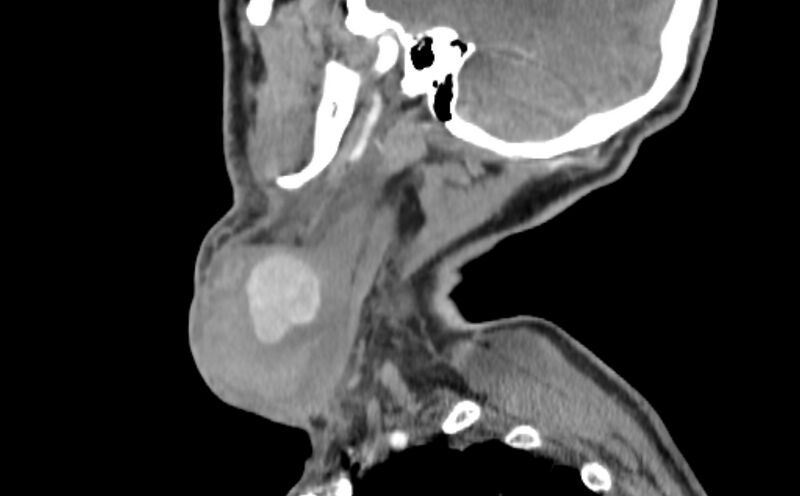 File:Carotid artery pseudoaneurysm (Radiopaedia 84030-99259 E 49).jpg