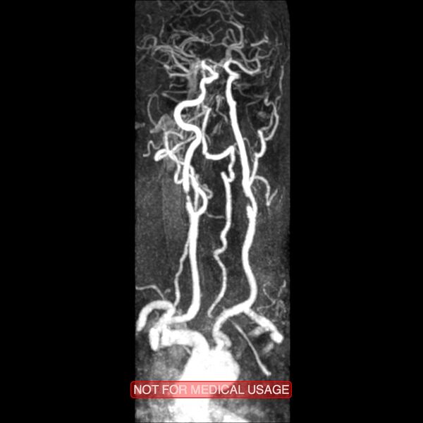 File:Carotid artery stenosis (Radiopaedia 28786-29087 3D MRA 4).jpg