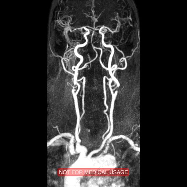 File:Carotid artery stenosis (Radiopaedia 28786-29087 3D MRA 8).jpg