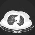 Carotid body tumor (Radiopaedia 21021-20948 Axial lung window 9).jpg
