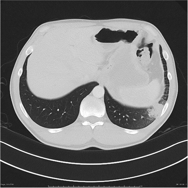 File:Cavitating lung cancer (Radiopaedia 25796-25945 Axial lung window 54).jpg