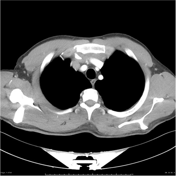 File:Cavitating lung cancer (Radiopaedia 25796-25945 C+ arterial phase 7).jpg