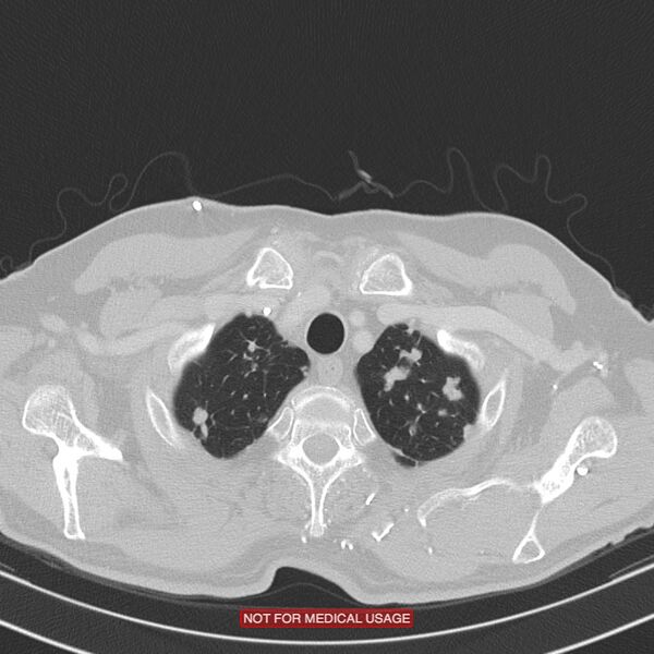 File:Cavitating pulmonary metastases (Radiopaedia 24920-25184 Axial lung window 1).jpg