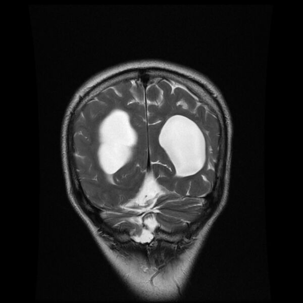 File:Central neurocytoma (Radiopaedia 67618-77021 Coronal T2 19).jpg