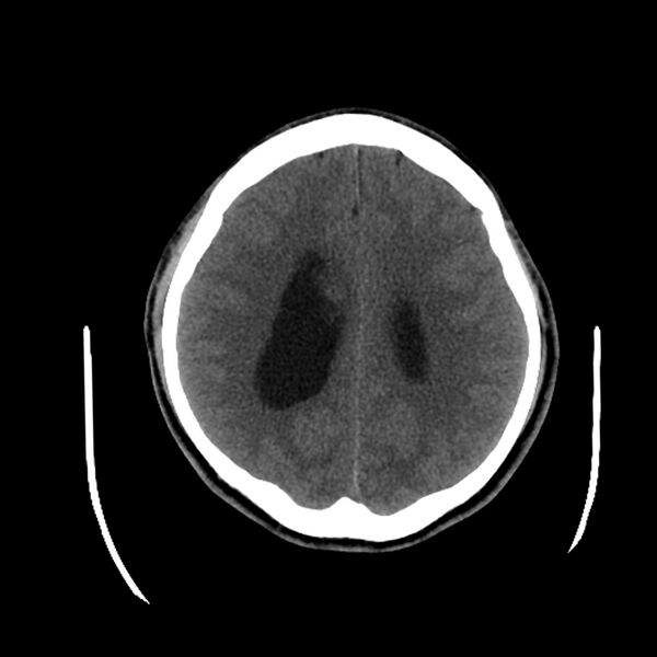 File:Central neurocytoma (Radiopaedia 79320-92379 Axial non-contrast 32).jpg
