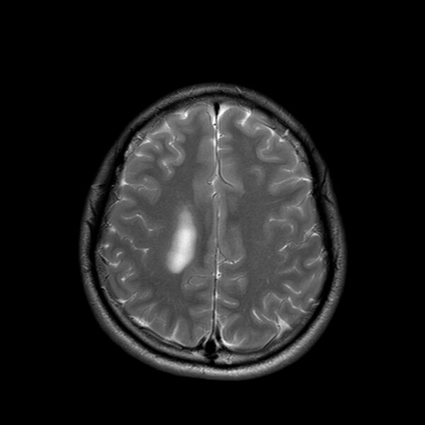 File:Central neurocytoma (Radiopaedia 79320-92380 Axial T2 21).jpg