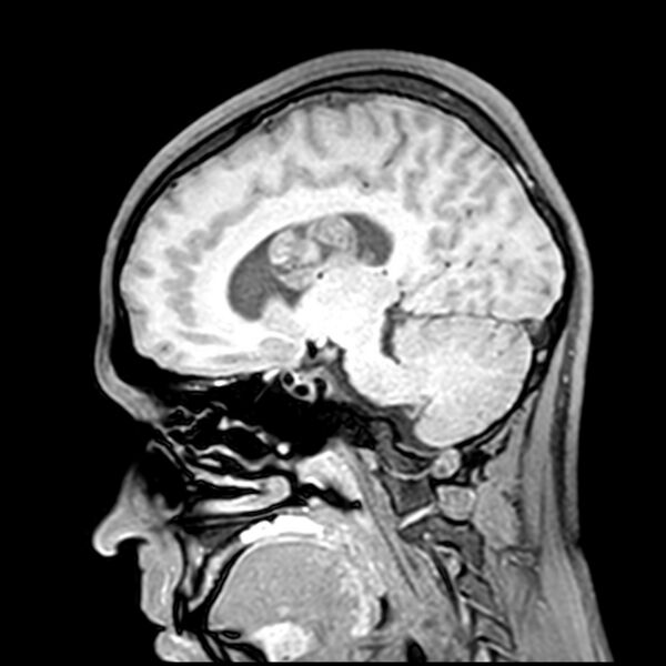 File:Central neurocytoma (Radiopaedia 79320-92380 Sagittal T1 112).jpg