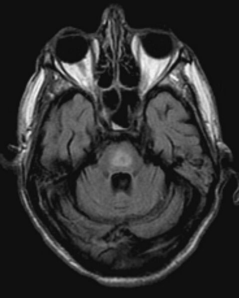 File:Central pontine myelinolysis (Radiopaedia 2598-6296 Axial FLAIR 1).jpg