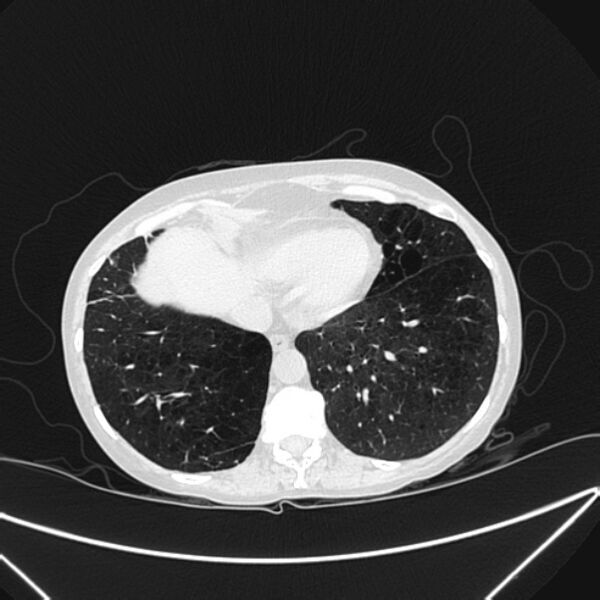 File:Centrilobular pulmonary emphysema (Radiopaedia 24495-24789 Axial lung window 74).jpg