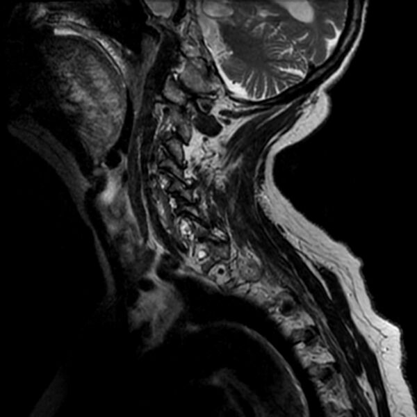 File:Cerebellar ataxia with neuropathy and vestibular areflexia syndrome (CANVAS) (Radiopaedia 74283-85159 Sagittal T2 10).jpg