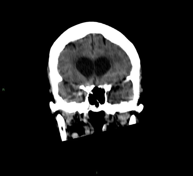 File:Cerebellar hemorrhage (Radiopaedia 58792-66026 Coronal non-contrast 43).jpg