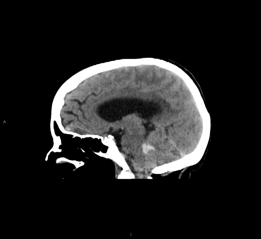 Cerebellar hemorrhage (Radiopaedia 58793-66027 C 29).jpg