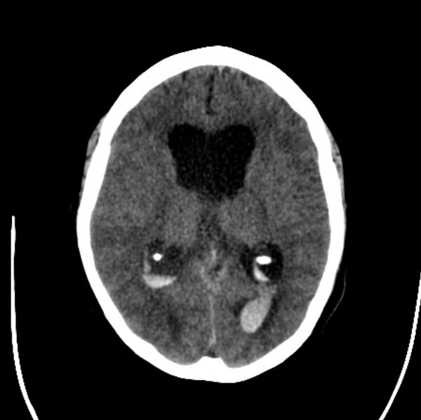 File:Cerebellar hemorrhage causing obstructive hydrocephalus (Radiopaedia 33989-35207 Axial non-contrast 27).jpg