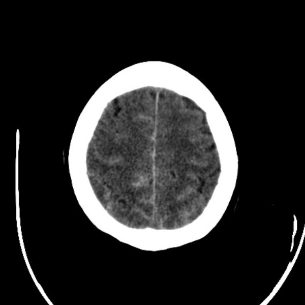 File:Cerebellar hemorrhage causing obstructive hydrocephalus (Radiopaedia 33989-35207 Axial non-contrast 43).jpg