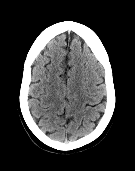 File:Cerebellar infarct due to vertebral artery dissection with posterior fossa decompression (Radiopaedia 82779-97033 Axial non-contrast 28).png