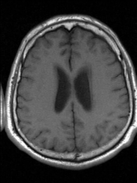 File:Cerebellopontine angle meningioma (Radiopaedia 24459-24764 Axial T1 16).jpg