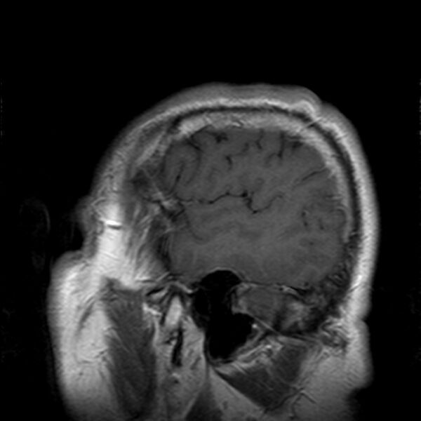 File:Cerebellopontine angle meningioma (Radiopaedia 24459-24764 Sagittal T1 C+ 23).jpg