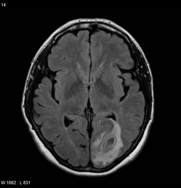 File:Cerebral abscess - shaggy borders (Radiopaedia 5492-7225 Axial STIR 1).jpg
