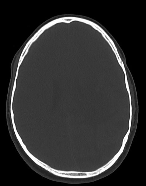 File:Cerebral abscesses (Radiopaedia 70458-80568 Axial bone window 39).jpg