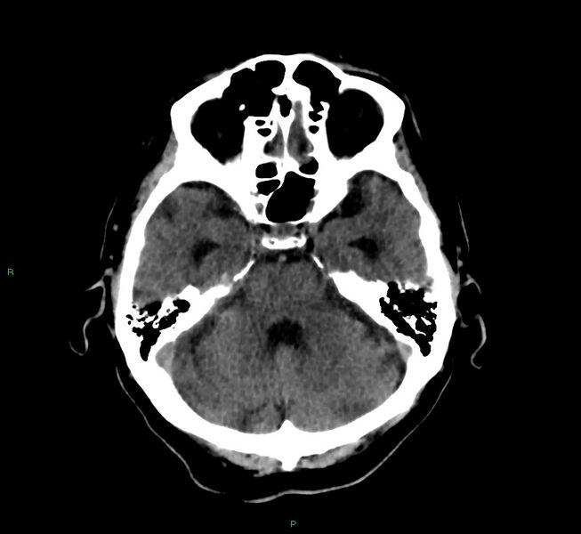 File:Cerebral amyloid angiopathy-associated lobar intracerebral hemorrhage (Radiopaedia 58376-65513 Axial non-contrast 37).jpg