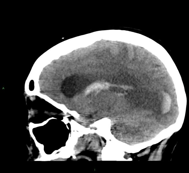 File:Cerebral amyloid angiopathy-associated lobar intracerebral hemorrhage (Radiopaedia 58379-65519 C 34).jpg