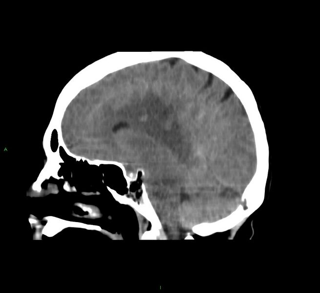 File:Cerebral amyloid angiopathy-associated lobar intracerebral hemorrhage (Radiopaedia 58751-65972 C 30).jpg