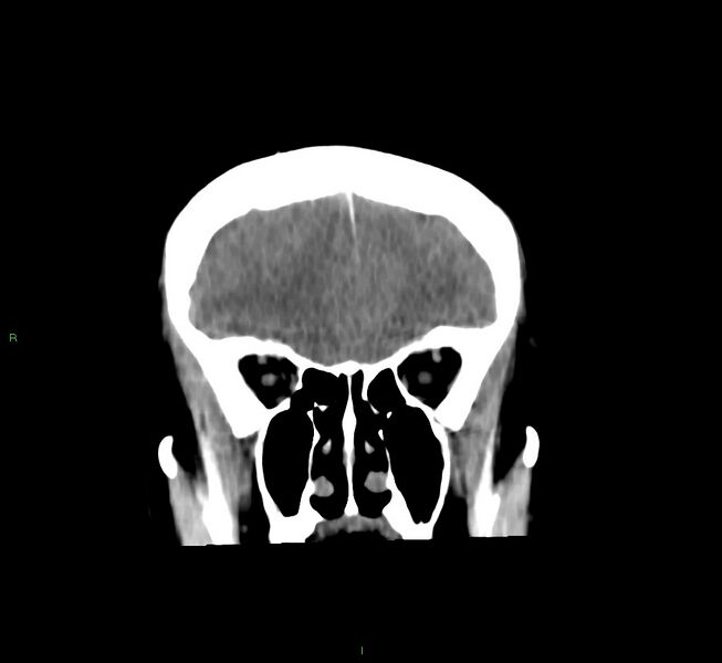 File:Cerebral amyloid angiopathy-associated lobar intracerebral hemorrhage (Radiopaedia 58756-65977 Coronal non-contrast 50).jpg