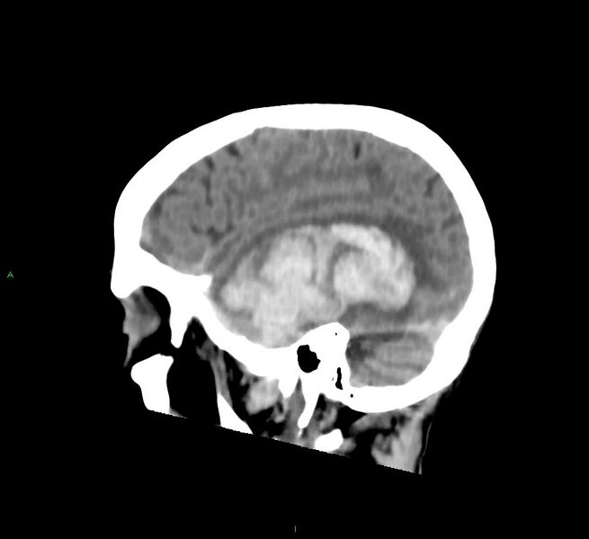 File:Cerebral amyloid angiopathy-associated lobar intracerebral hemorrhage (Radiopaedia 58758-65980 C 14).jpg