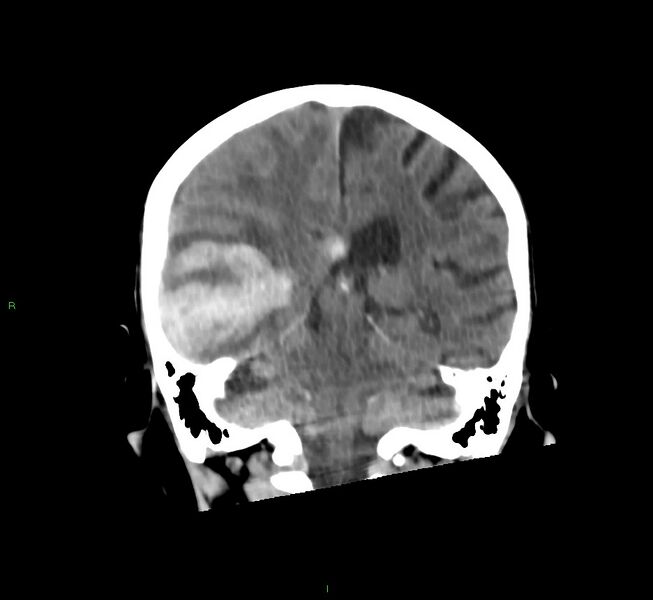 File:Cerebral amyloid angiopathy-associated lobar intracerebral hemorrhage (Radiopaedia 58758-65980 Coronal non-contrast 27).jpg
