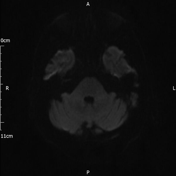 File:Cerebral amyloid angiopathy related inflammation (Radiopaedia 72772-83415 Axial DWI 53).jpg